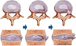 hernia_folyamat
